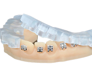 Indirect Bonding Trays
